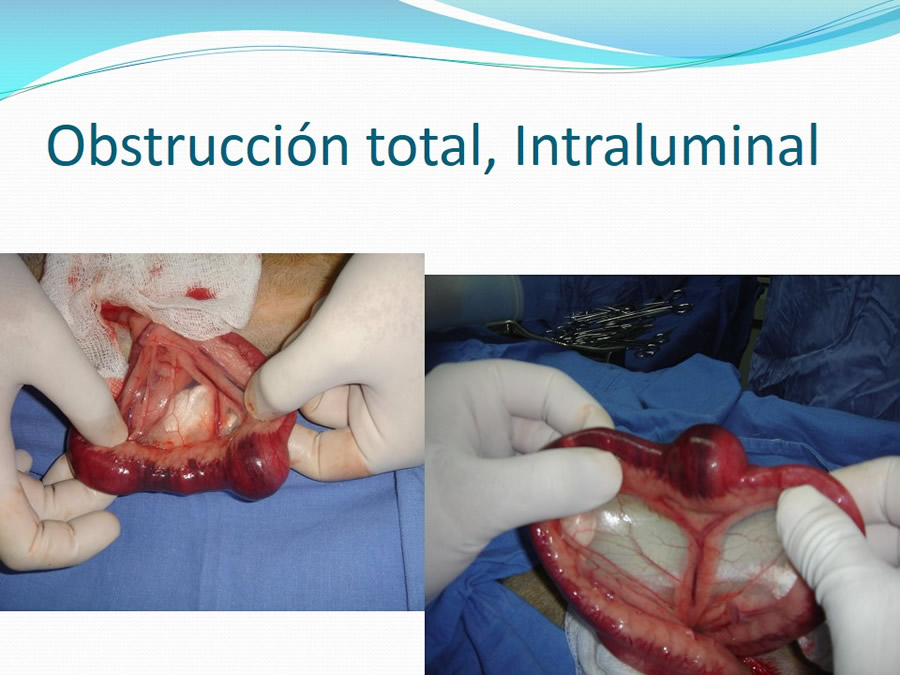 Obstruccin intestinal