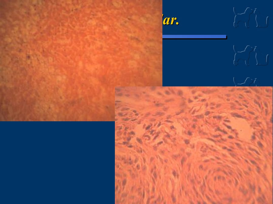 Carcinoma Hepatocelular