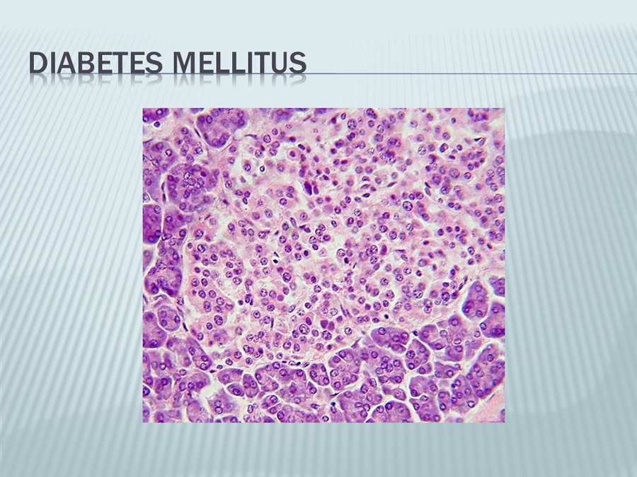 Diabetes Mellitus