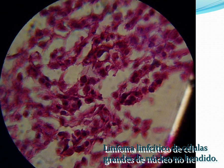 Obstruccin intestinal