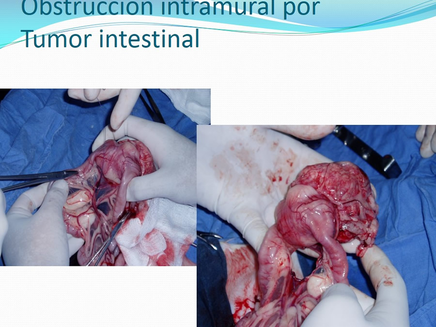 Obstruccin intestinal