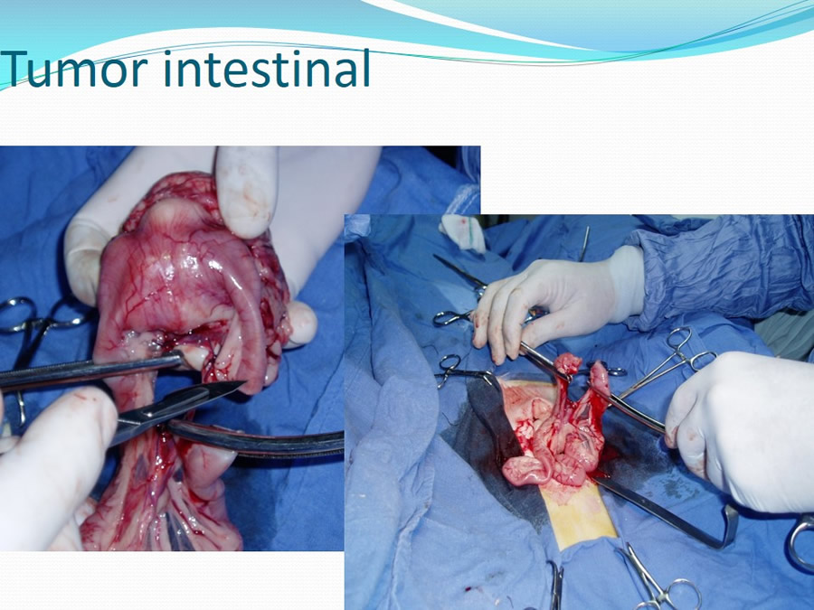 Obstruccin intestinal