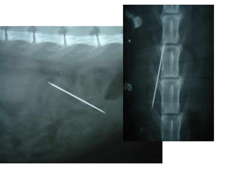 Obstruccin intestinal