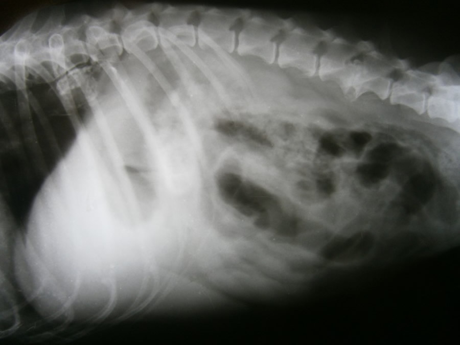 Obstruccin intestinal