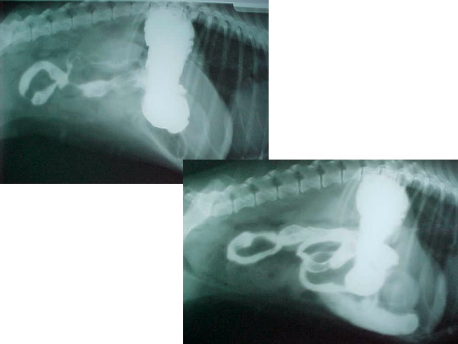 Obstruccin intestinal