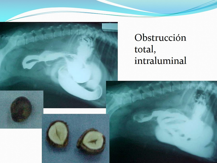 Obstruccin intestinal