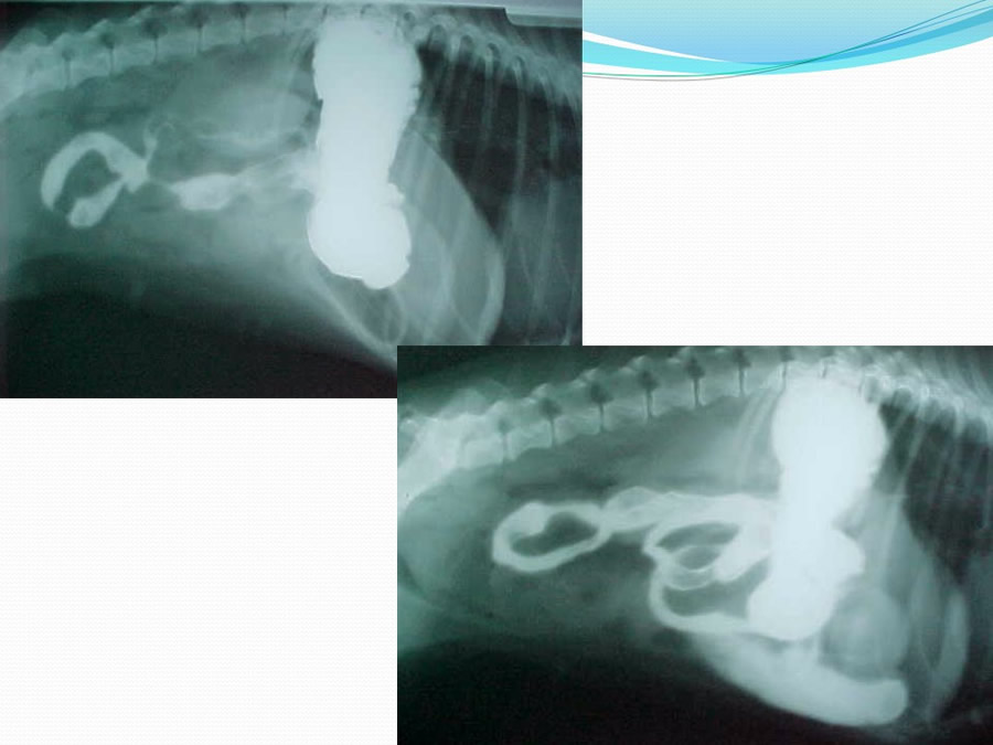 Obstruccin intestinal