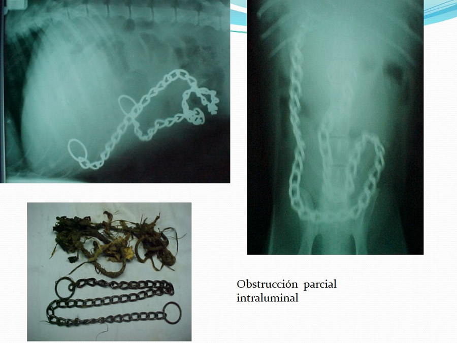 Obstruccin intestinal