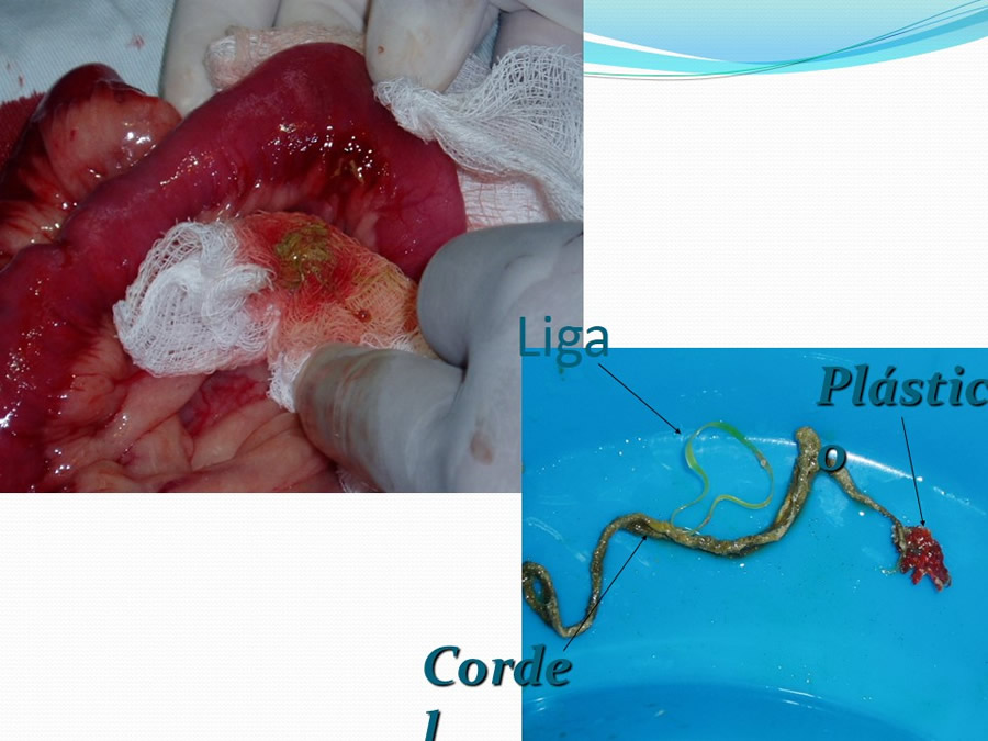 Obstruccin intestinal