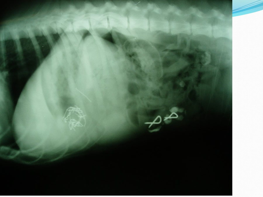 Obstruccin intestinal