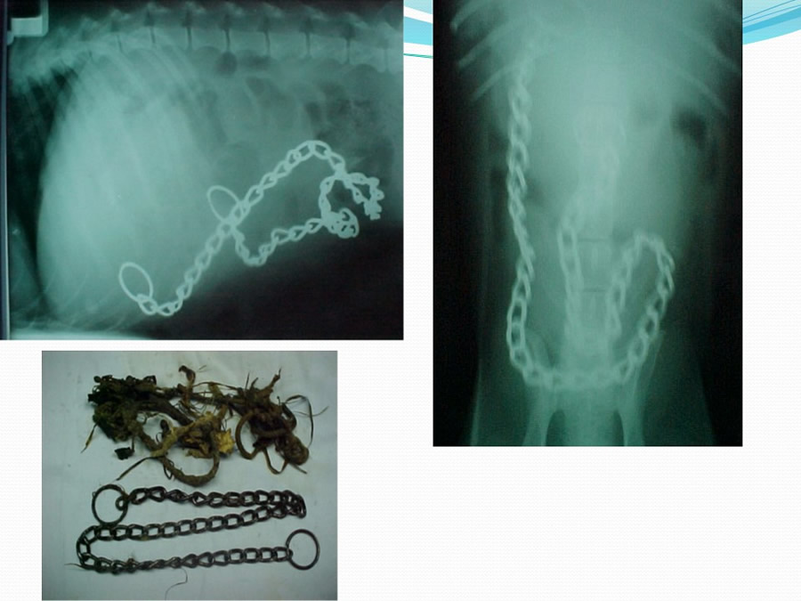 Obstruccin intestinal