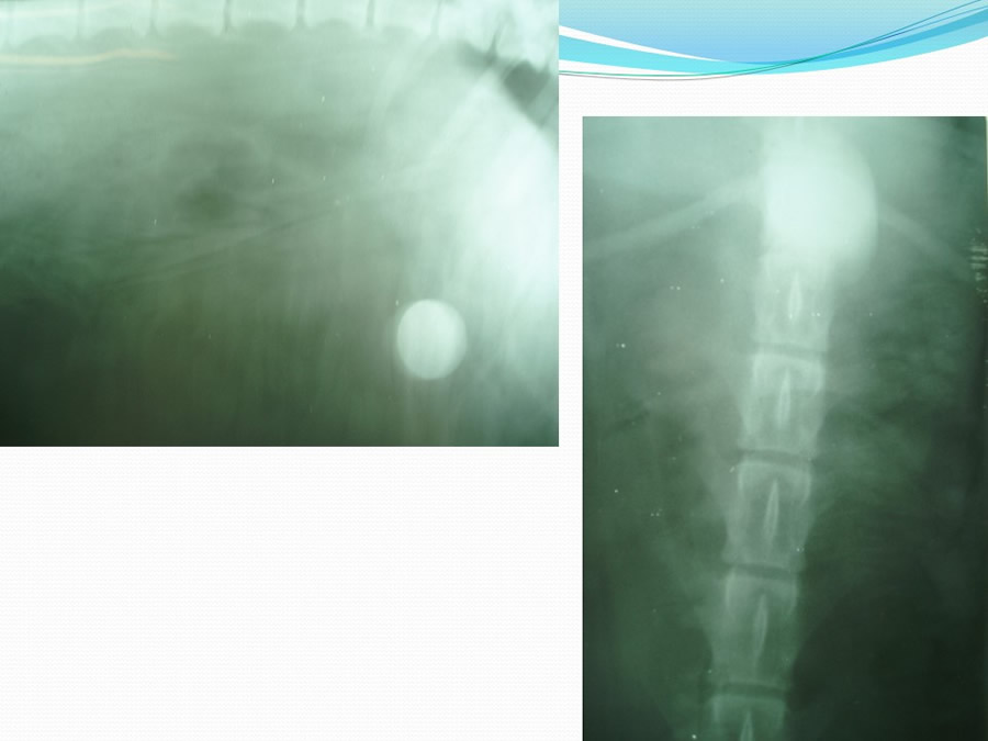 Obstruccin intestinal