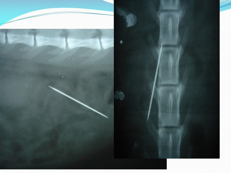 Obstruccin intestinal