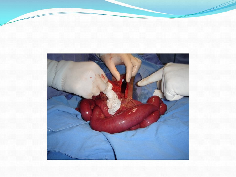 Obstruccin intestinal