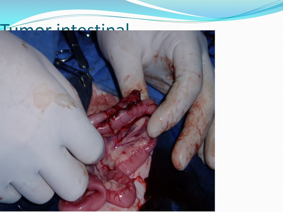 Obstruccin intestinal