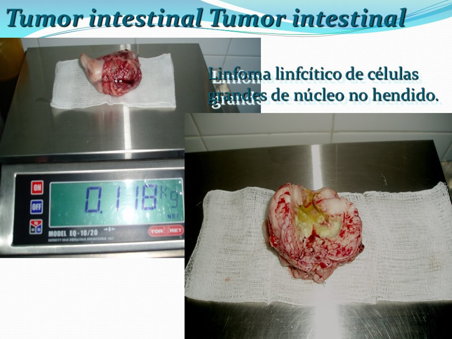 Obstruccin intestinal