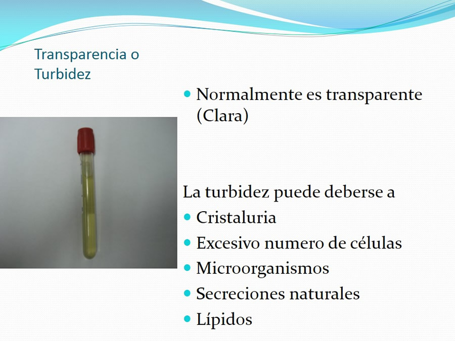 Urolitiasis