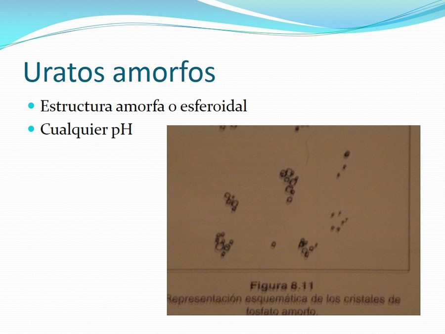 Urolitiasis