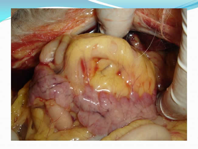 Hipoglucemia